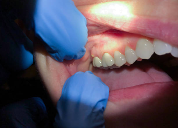 Best Broken Tooth Emergency  in Belmont, WI